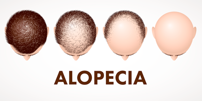 alopecia-mobile.png