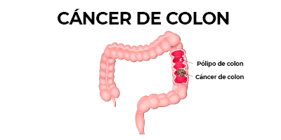 cancer de colon movil.png