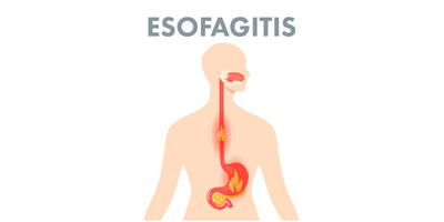 esofagitis-mobile.png