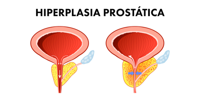 hiperplasia-prostatica-mobile.png