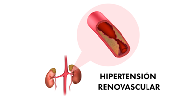 hipertension-renovascular-mobile.png