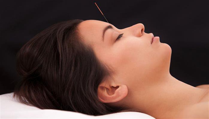 la-acupuntura-es-un-tratamiento-efectivo-y-seguro-para-la-migrana