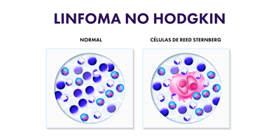 linfoma-no-hodgkin-mobile.png