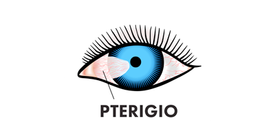 pterigio-mobile.png