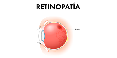 retinopatia-mobile.png