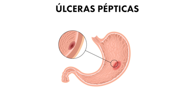 ulceras-pepticas-mobile.png